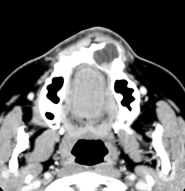 Axial liver window ameloblastoma