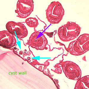 Higher magnification (200x) of the cyst in Figure 3, showing daughter cyst (brood capsule). Note the hooklets (purple arrow) inside one of the protoscoleces and the calcareous corpuscles (light blue arrows) along the germinal layer. Adapted from CDC