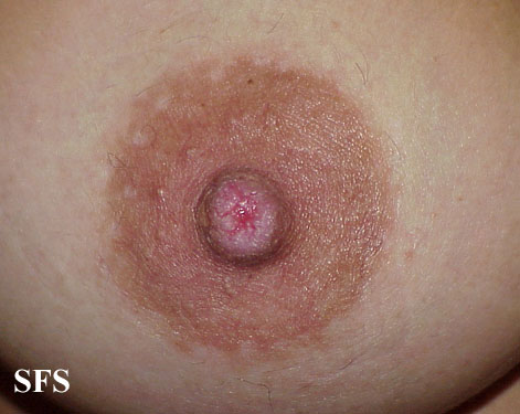 Paget's Disease of the Nipple - Breast Cancer Information ...