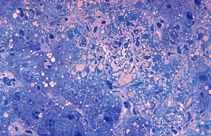 This photomicrograph demonstrates hepatitis caused by the Lassa virus, using toluidine-blue azure II stain, magnified 500X.Retrieved from the Public Health Image Library (PHIL), Centers for Disease Control and Prevention.[10]