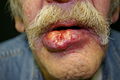 Large squamous cell cancer (SCC) of lower lip