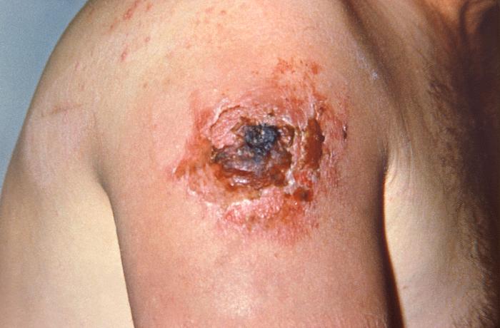 File:Smallpox-8.jpg