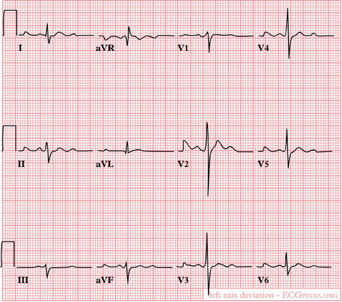 A left heart axis is present when the QRS in lead I is positive and negative in II and III.