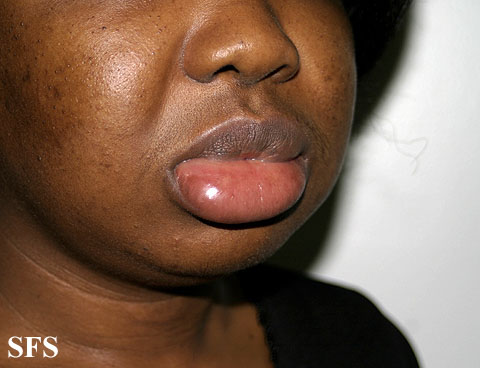 Angioedema. Adapted from Dermatology Atlas.[1]