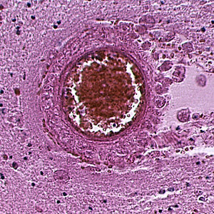 Cyst of B. mandrillaris in brain tissue, stained with hematoxylin and eosin (H&E). Adapted from CDC
