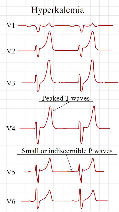 Tall, symmetric, narrow based T waves in a hyperkalemic patient.