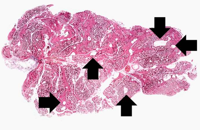 This is a low-power photomicrograph of muscle fascicles containing large gas bubbles (arrows). Note that there is no inflammatory reaction in this section.