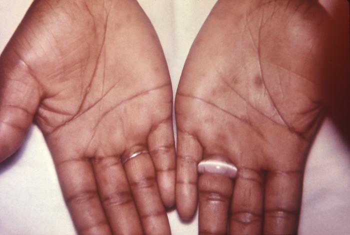 This patient presented with secondary syphilytic lesions on the palms of her hands. The second stage starts when one or more areas of the skin break into a rash that appears as rough, red or reddish brown spots both on the palms of the hands and on the bottoms of the feet. Even without treatment, rashes clear up on their own. Adapted from CDC