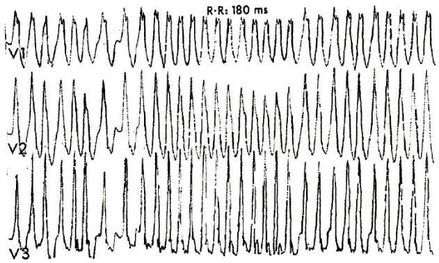 File:Wpw with afib.PNG