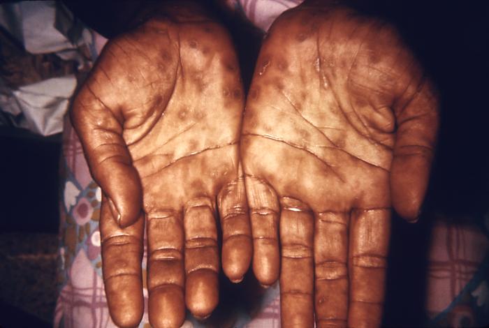 This patient presented with secondary syphilytic lesions on the palms. The second stage starts when one or more areas of the skin break into a rash that appears as rough, red or reddish brown spots both on the palms of the hands and on the bottoms of the feet. Even without treatment, rashes clear up on their own. Adapted from CDC
