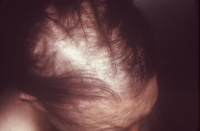 This patient presented with a case of alopecia during the secondary stage of syphilis. Second-stage symptoms can include fever, swollen lymph glands, sore throat, patchy hair loss, headaches, weight loss, muscle aches, and tiredness. The disease can easily be passed to sex partners during the primary or secondary stages. Adapted from CDC