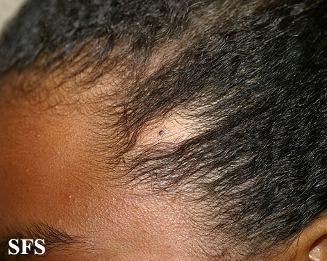 Alopecia acquisitum centrifugum. Adapted from Dermatology Atlas.[5]