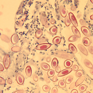 Eggs of C. hepatica in liver stained with H&E. Adapted from CDC