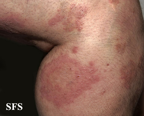 File:Dermatitis herpetiformis40.jpg