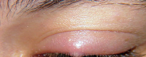 Hordeolum. With permission from Dermatology Atlas.[5]