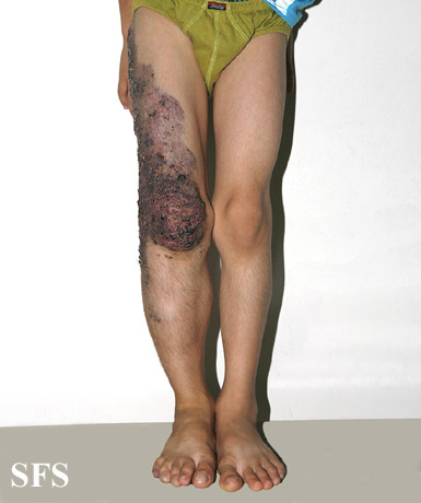 .:Klippel Trenaunay Syndrome Adapted from Dermatology Atlas.[7]