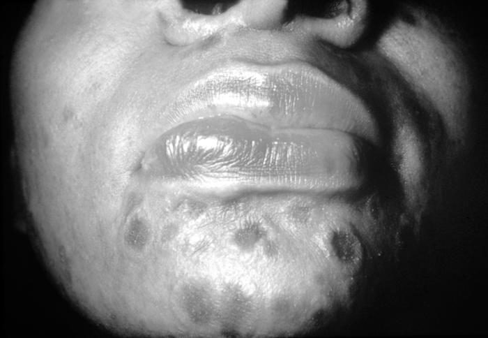 A photograph of a patient with secondary syphilis showing typical "nickel and dime" lesions on the face. A patient with typical "nickel and dime" lesions on the face, which can develop during secondary syphilis. Other symptoms that may occur during this stage are mild fever, fatigue, headache, sore throat, patchy hair loss, and swollen lymph glands. Adapted from CDC