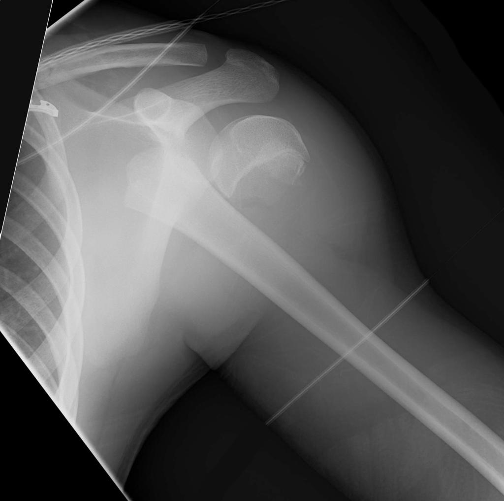 File:Salter-Harris type I injury of shoulder.jpg