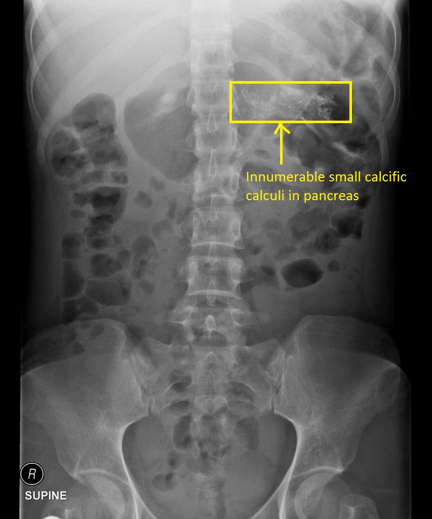 Chronic pancreatitis abdominal x ray - wikidoc