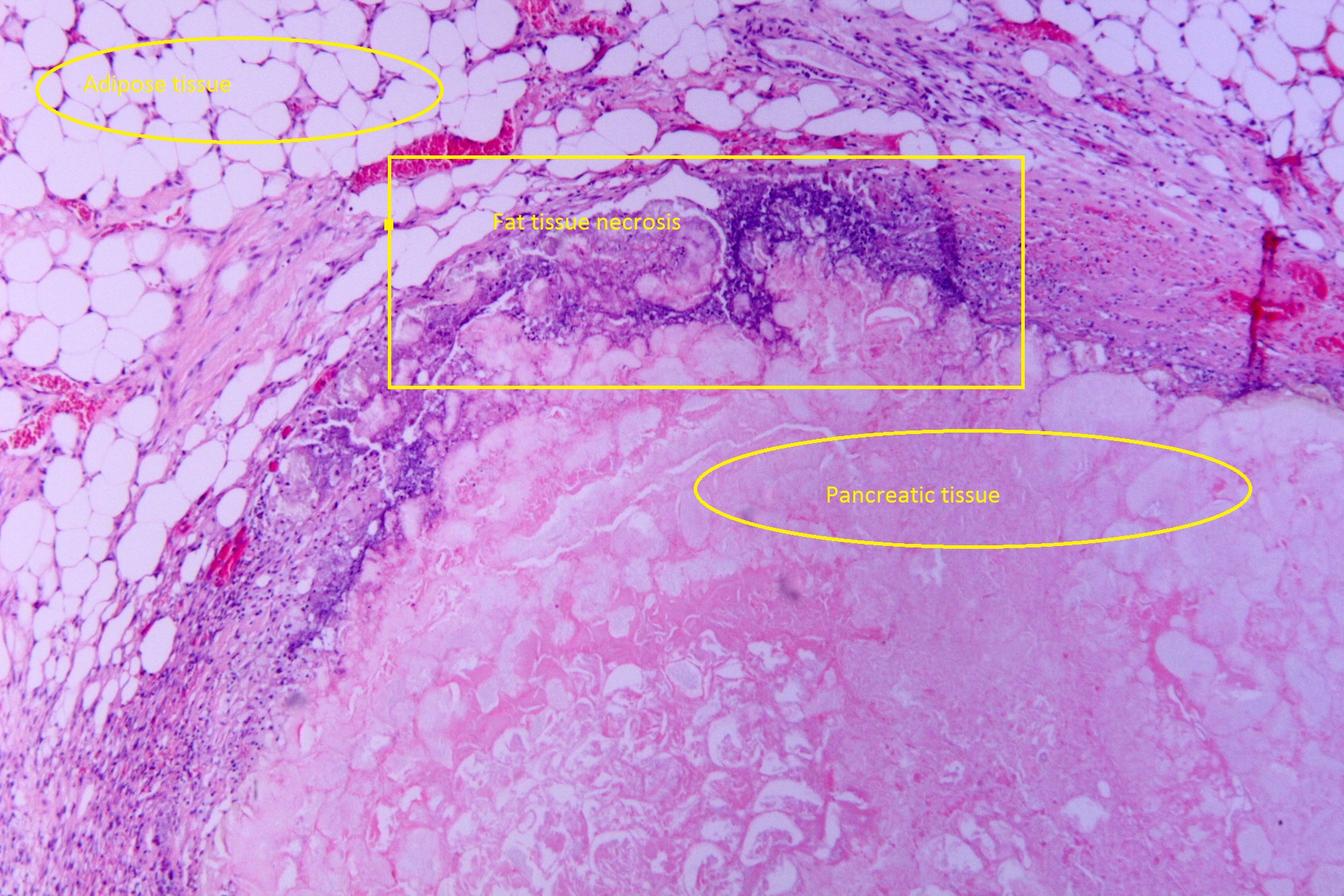 File:Tryptic fat tissue necrosis in severe pancreatitis, HE 1.jpg