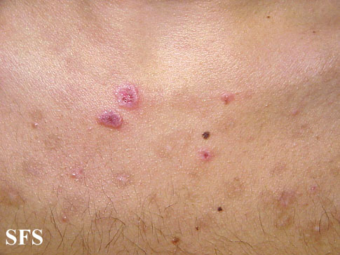 Eosinophilic pustular folliculitis. Adapted from Dermatology Atlas.[10]