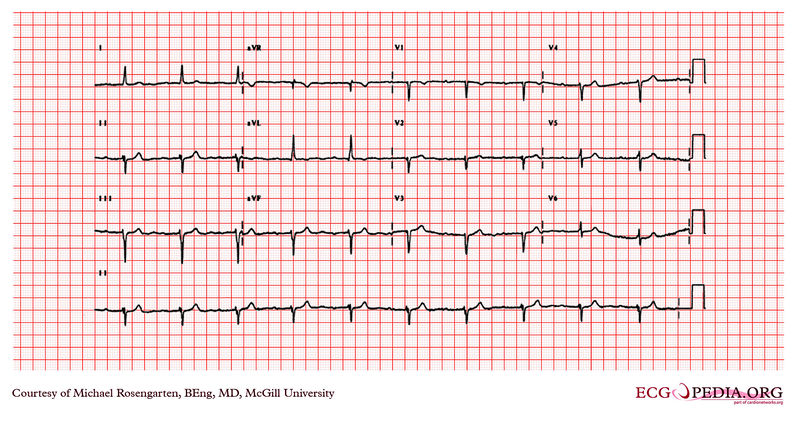 File:First degree heart block1.jpg