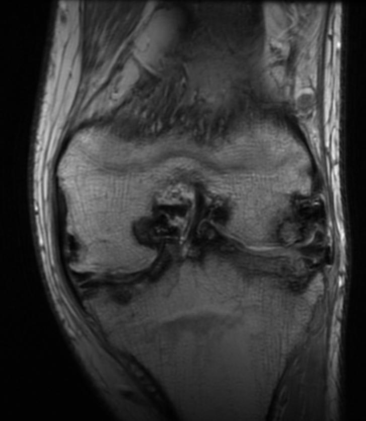File:Hemophilia knee MRI 105.jpg