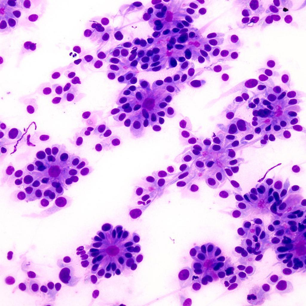 True ependymal rosette consisting of tumor cells arranged around well-defined lumens forming gland-like structures.