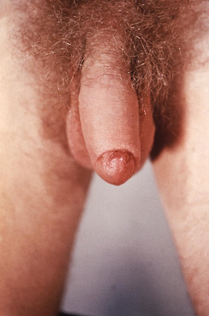 This patient with a primary staged syphilis infection presented with phimosis of the penile foreskin. Due to the formation of a primary syphilitic chancre, adhesions developed affixing the foreskin to the glans penis resulting in a condition known as phimosis, where the foreskin cannot be retracted in order to expose the entire glans.