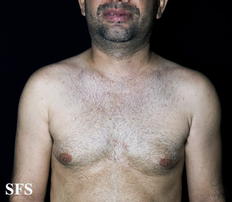 File:Acquired hypomelanosis post sympathectomy 01.jpeg