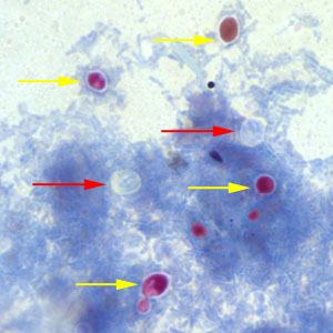 Cryptosporidium sp. oocysts (red arrows) that did not take up the modified acid-fast stain. The slide was counterstained with methylene blue. Note that yeast cells did stain red (yellow arrows). Adapted from CDC