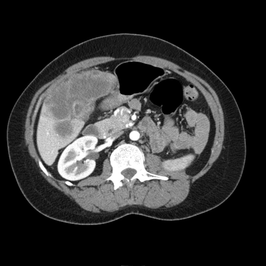 File:Gallbladder-adenocarcinoma-1.jpg