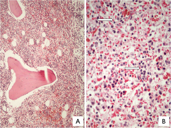 A: Bone marrow biopsy showing cellular marrow with diffuse intrasinusoidal and interstitial lymphoid cell infiltrates (Jenner Giemsa, ×100); B: Arrows indicating intrasinusoidal lymphoid cell infiltrate (Jenner Giemsa, ×400).[4]