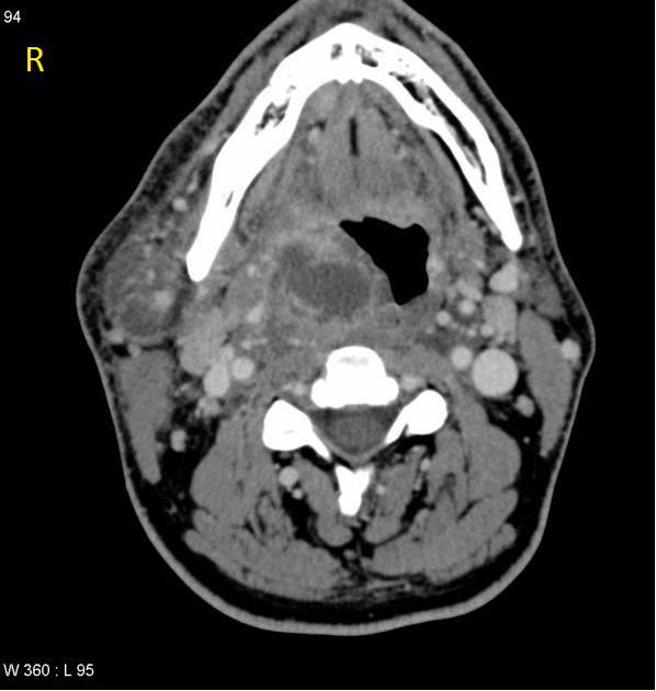 File:Retropharyngeal abscess CT-axial.gif