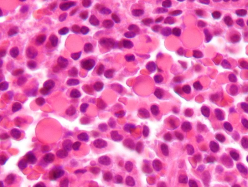 Multiple myeloma slide with russell bodies[4]