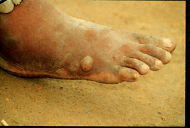 The female Guinea worm induces a painful blister. Adapted from CDC