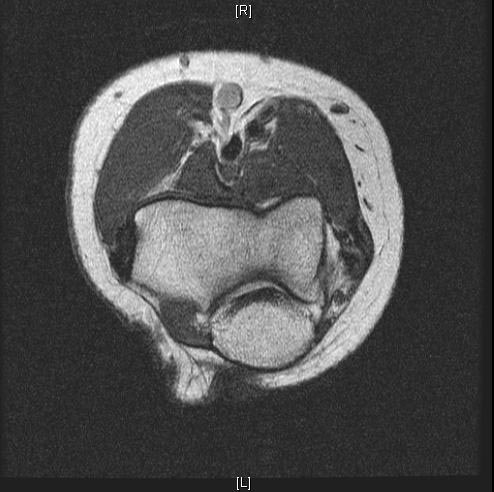 File:Normal-elbow-MRI-004.jpg