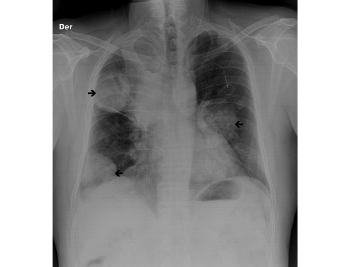 File:Pulmonary Metastases from Colorectal Cancer X-ray.jpg