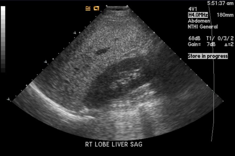 File:Fatty infiltration of liver ultrasound 103.jpg