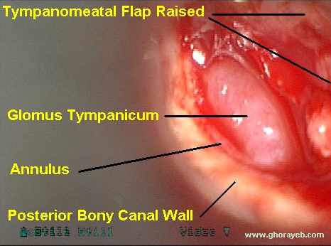 Surgical picture of the above patient. A tympanomeatal flap has been elevated and reflected anteriorly to expose the glomus tympanicum that filled the posterior half of the middle ear space[4].