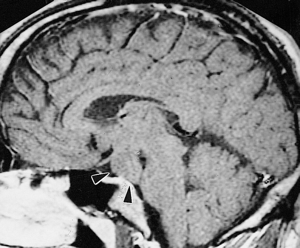 MRI showing hypothalamic hamartoma