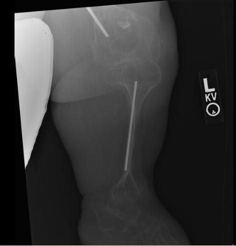 File:Osteogenesis-imperfecta-106.jpg