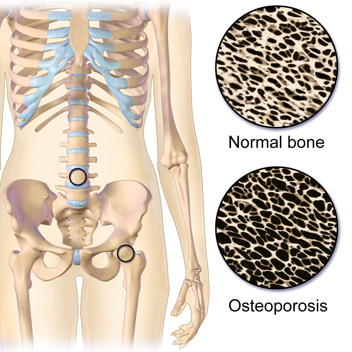 File:Osteoporosis Locations.png