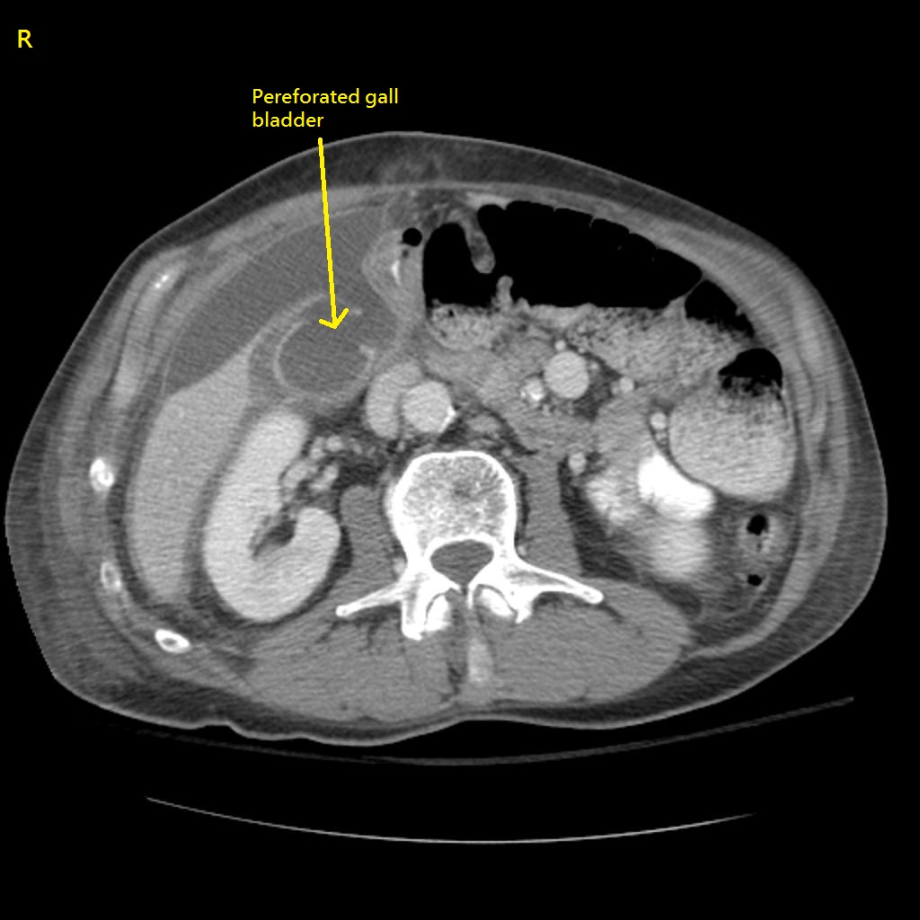 File:Perforated-gallbladder-with-bile-peritonitis.jpg