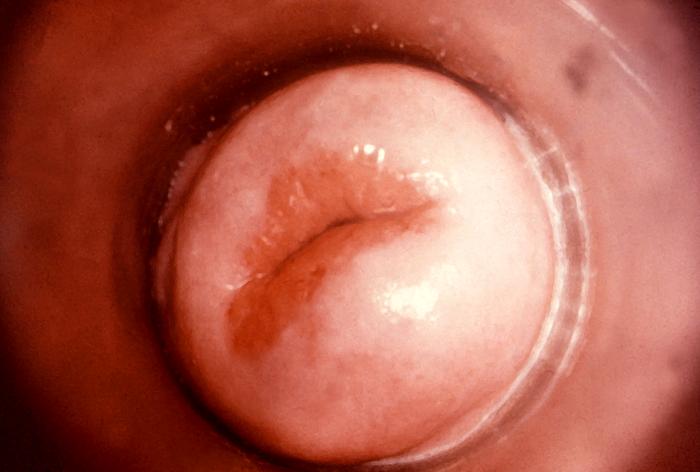 This colposcopic view of this patient’s cervix reveled an eroded ostium due to Neisseria gonorrhea infection. A chronic Neisseria gonorrhea infection can lead to complications, which can be apparent such as this cervical inflammation, and some can be quite insipid, giving the impression that the infection has subsided, while treatment is still needed. Adapted from CDC
