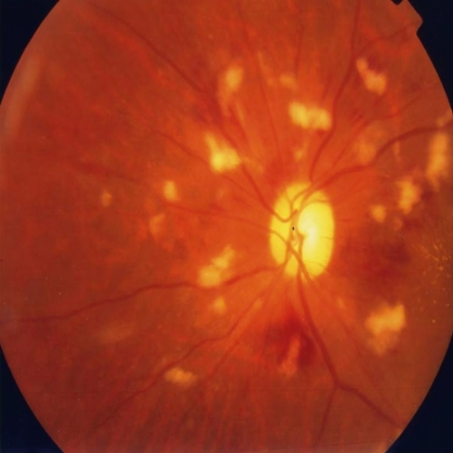 File:Dilation and tortosity of retinal veins.png