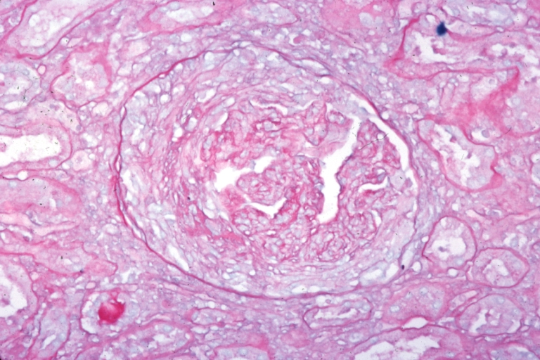 Kidney: Lupus Erythematosus: Micro high mag PASH typical glomerulonephritis lesion with crescent