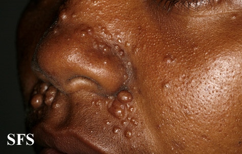 Trichoepithelioma. Adapted from Dermatology Atlas.[4]