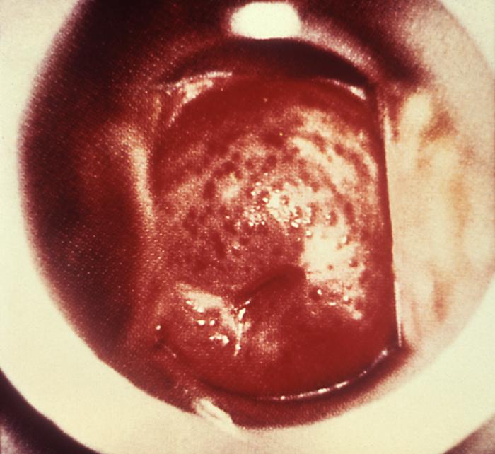 This patient presented with a "strawberry cervix” due to a Trichomonas vaginalis infection, or trichomoniasis. The term “strawberry cervix” is used to describe the appearance of the cervix due to the presence of T. vaginalis protozoa. The cervical mucosa reveals punctate hemorrhages along with accompanying vesicles or papules.