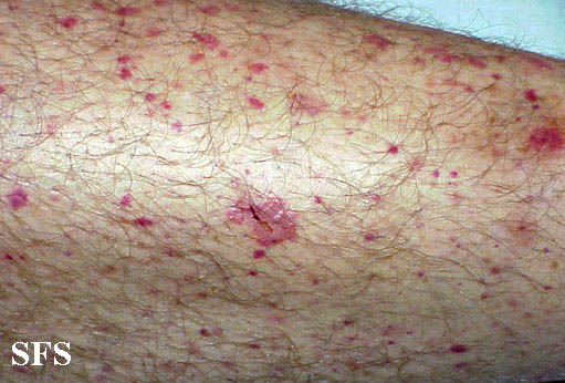 .Allergicvasculitis Adapted from Dermatology Atlas.[1]